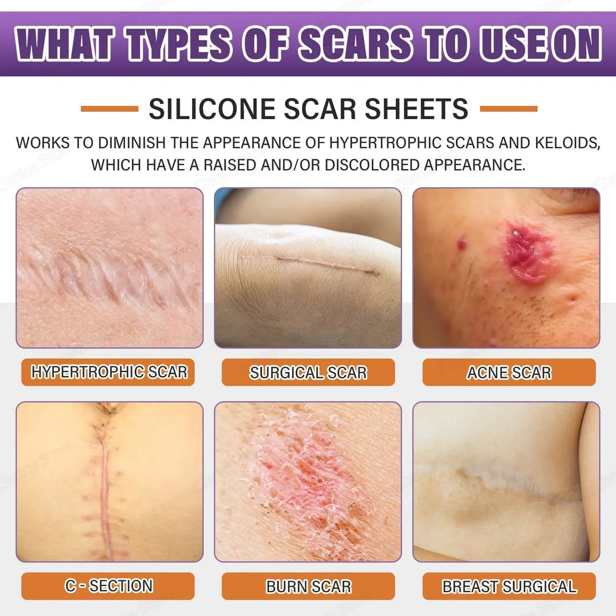 AlignWell ScarFade Silicone Scar Sheets